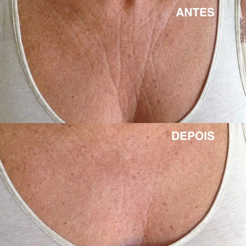 Adesivos antirrugas de silicone para a área do Colo "Chega de Rugas"