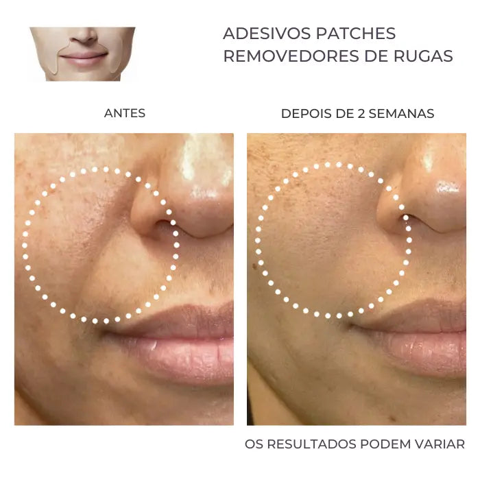Adesivos faciais reutilizáveis antirrugas - 16 unidades