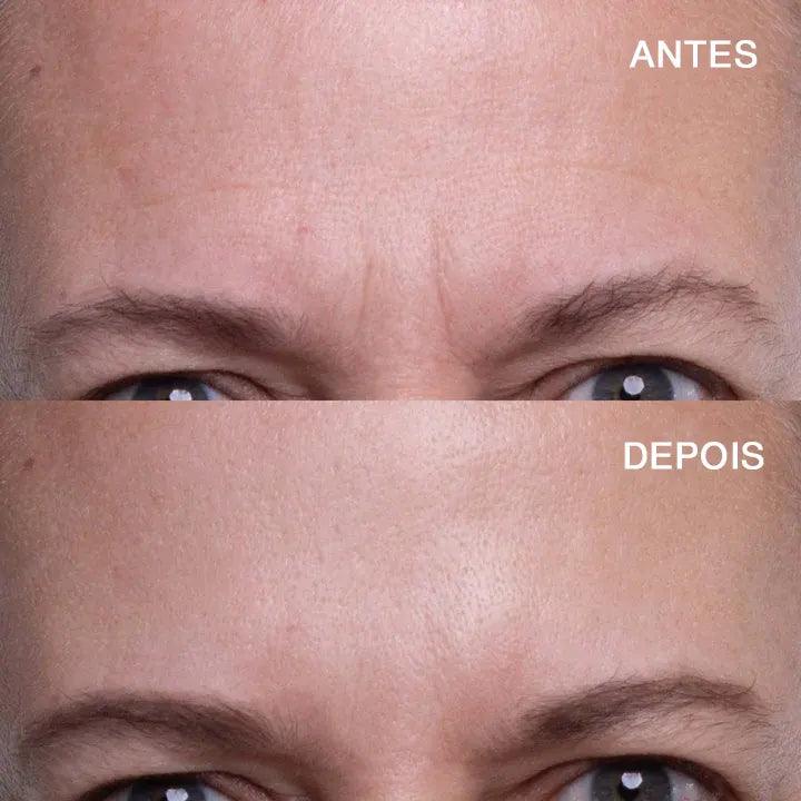 Adesivo para testa antirrugas